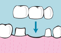 begley dental bridging