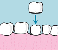 begley dental crowning