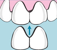 begley dental veneers